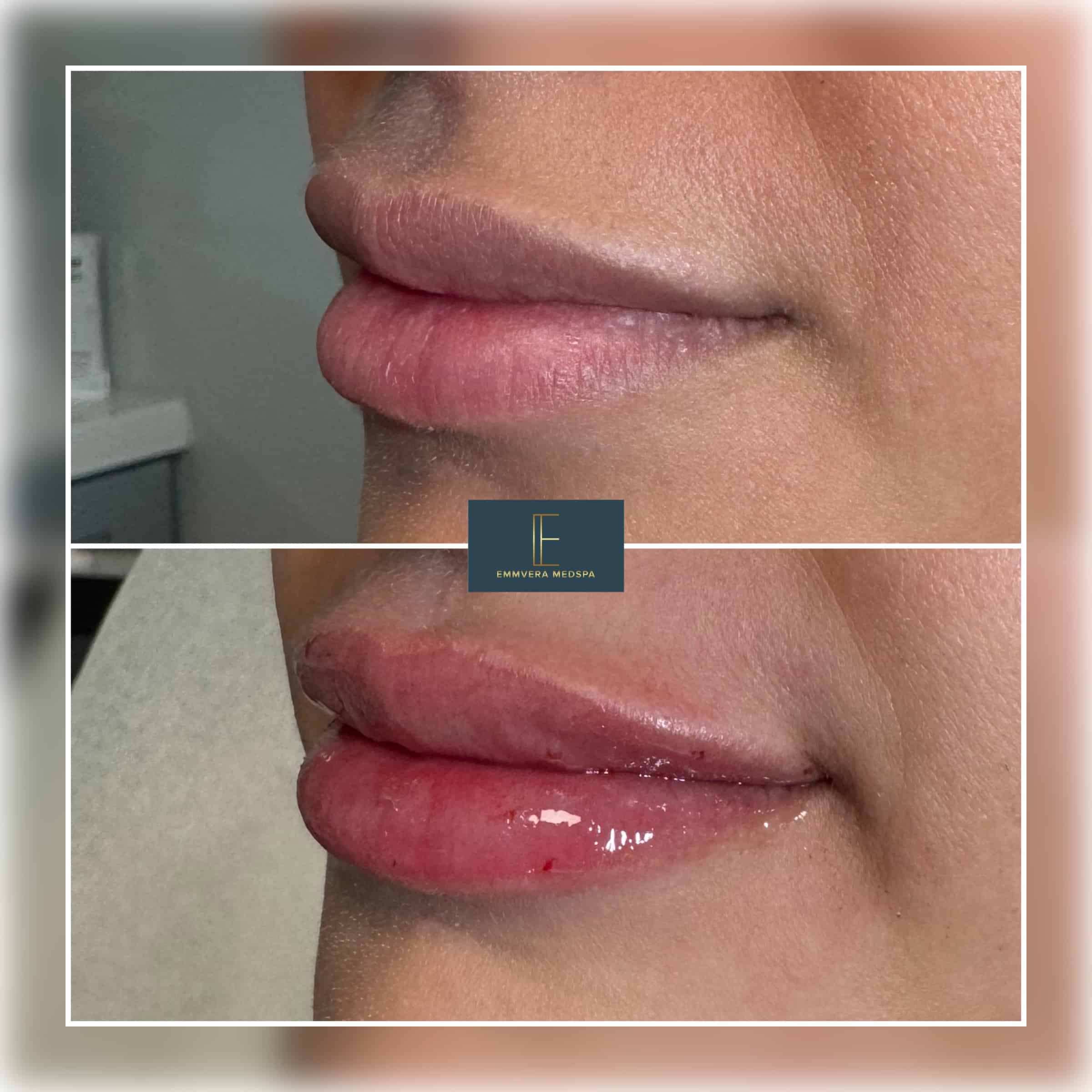 Before and After Image: Dermal Filler - left-front-oblique