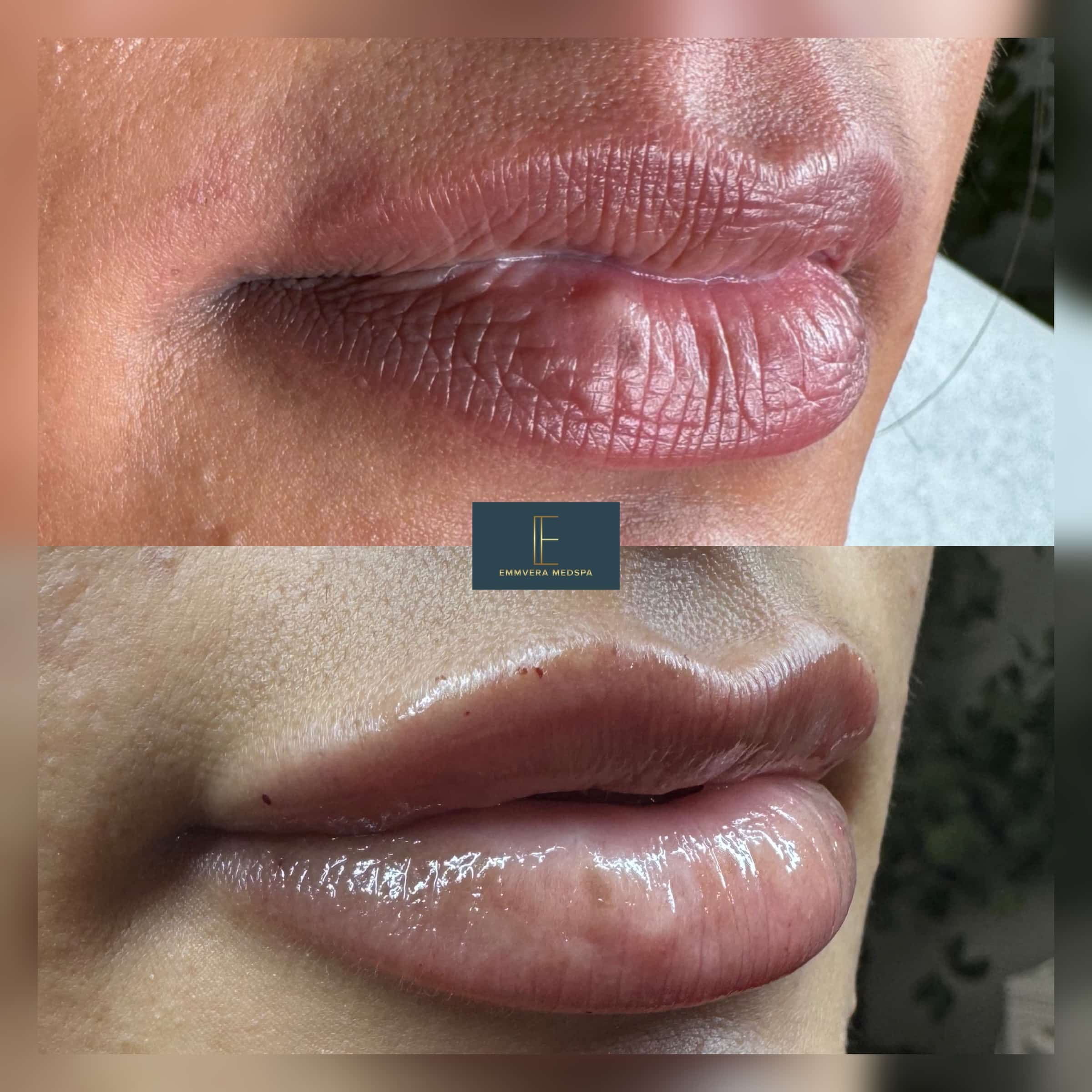 Before and After Image: Dermal Filler - right-front-oblique