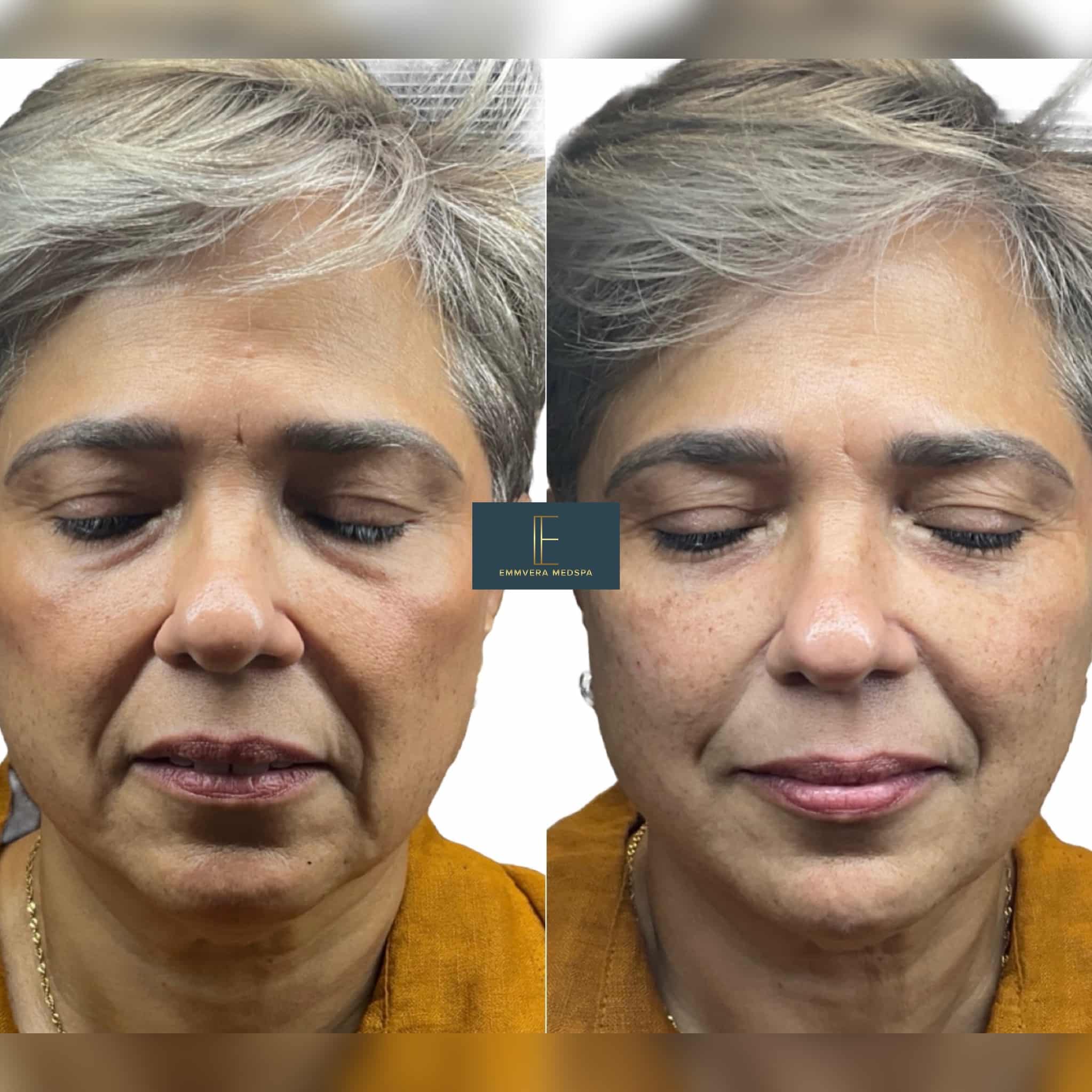 Before and After Image: Dermal Filler - front