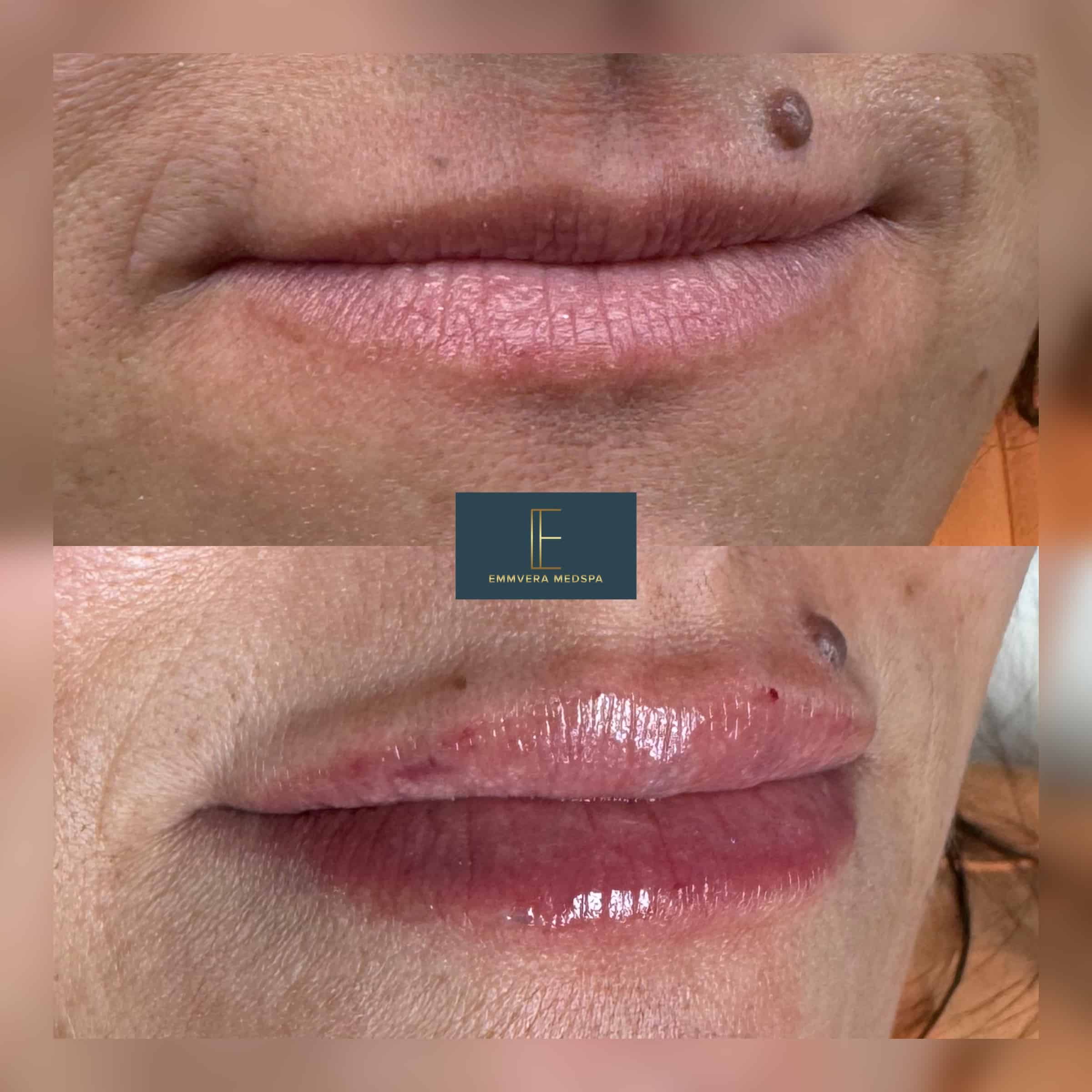 Before and After Image: Dermal Filler - right-front-oblique