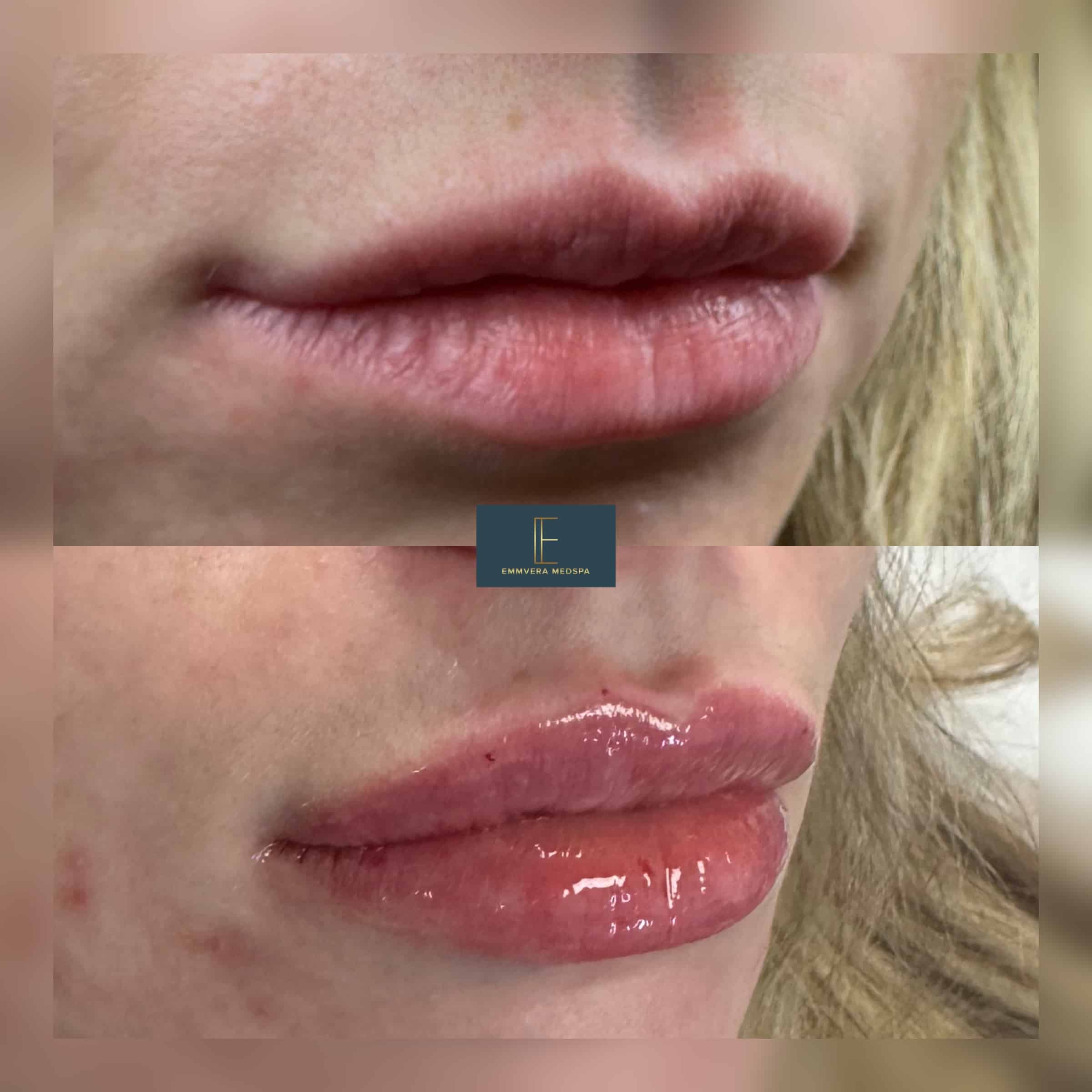 Before and After Image: Dermal Filler - right-front-oblique