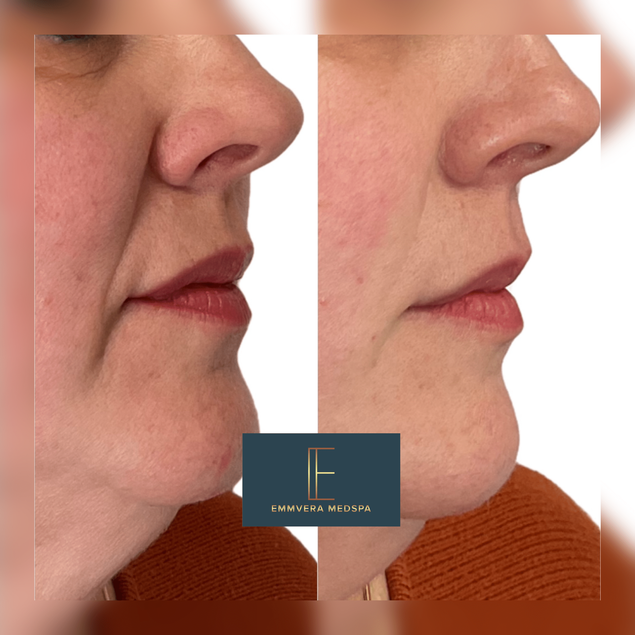 Before and After Image: Dermal Filler - right-side