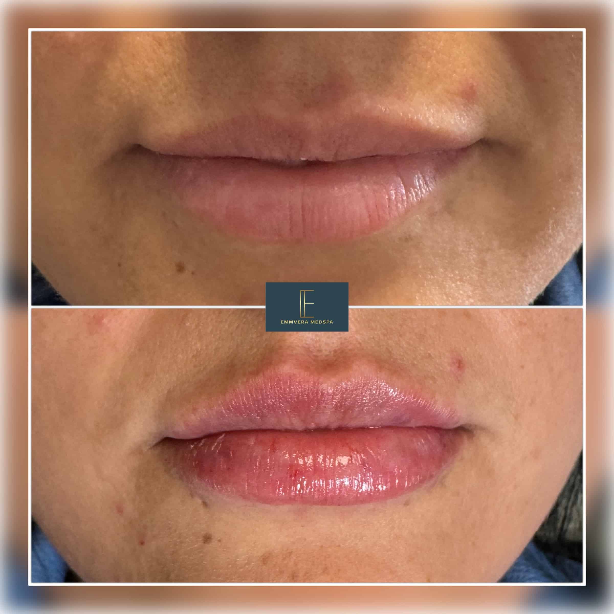 Before and After Image: Derma Filler - front