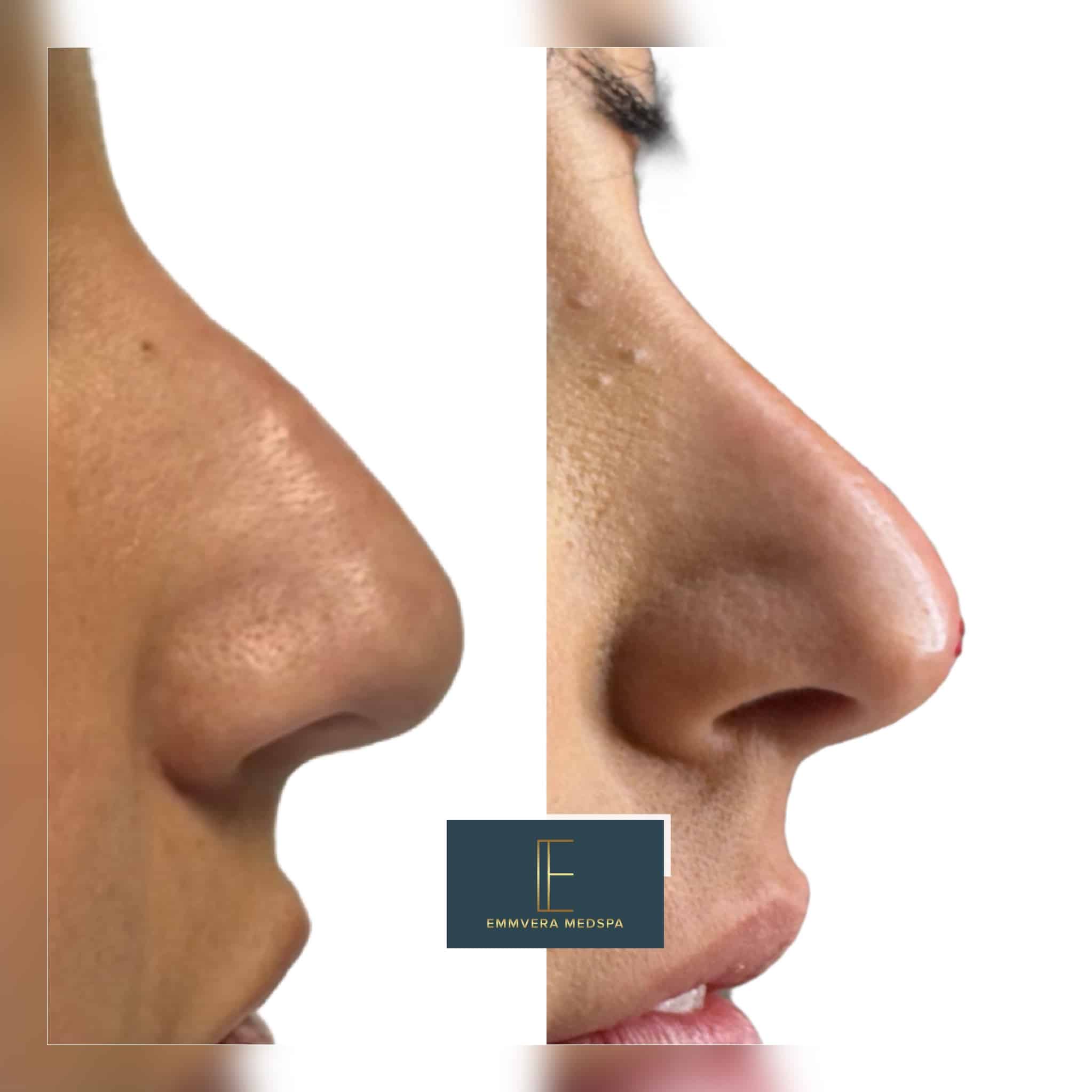 Before and After Image: Derma Filler - right-side