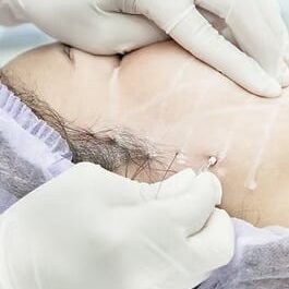 PDO Suture operationface lifting surgery (Series) beauty clinical concept